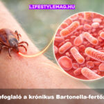 Krónikus Bartonella fertőzés, bartonellózis: Összefoglaló