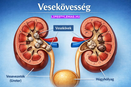 Vesekövesség - vesekő okai, fajtái, tünetei, kezelése, szövődményei, megelőzése