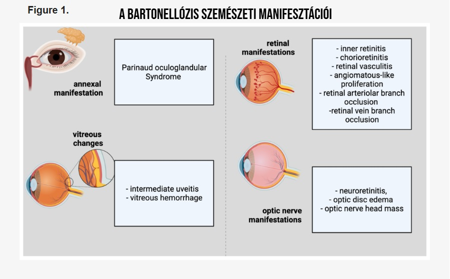 A Bartonella, bartonellózis, cat scratch disease - csd (macskakarmolási betegség), Bartonella henselae szemészeti szövődményei, tünetei