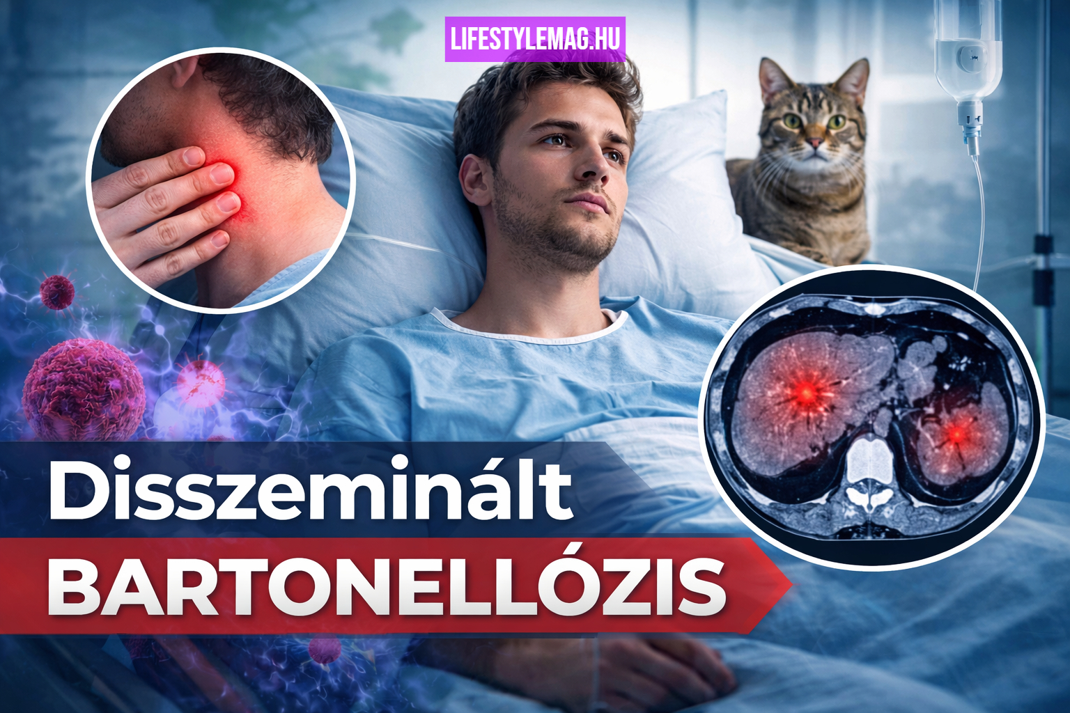 12 disszeminált bartonellózis (Bartonella-fertőzés) beteg esete