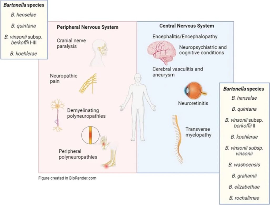 neurobartonellózis anatómiai ábra a  Bartonella perifériás idegrendszeri és központi idegrendszeri tüneteiről, szövődményeiről, manifesztációiról