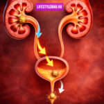 A vesekő távozása, útja - Avagy honnan tudom, hogy hol tart a vesekő?